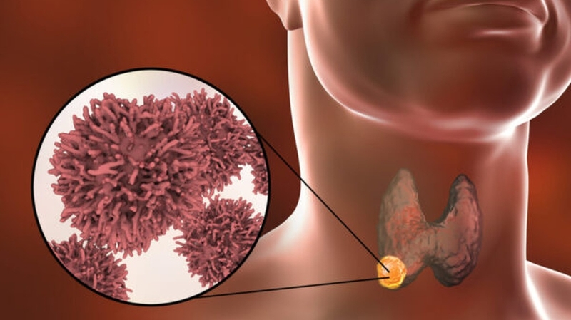 Nhận biết dấu hiệu ung thư tuyến giáp giai đoạn cuối 2