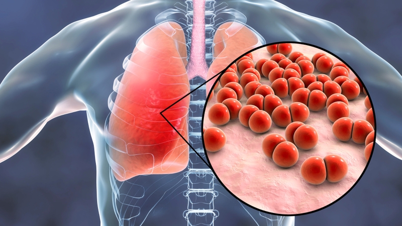 Triệu chứng viêm phổi ở trẻ sơ sinh cha mẹ cần nhận biết sớm 3