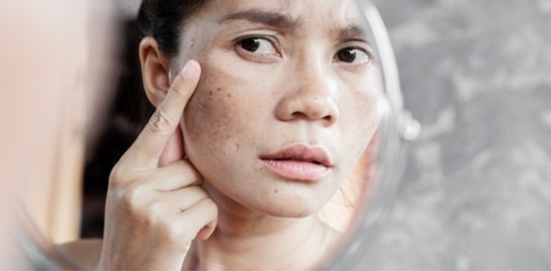 Nhận biết đồi mồi và cách điều trị cho các chị em 1