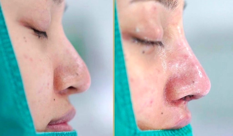 Nhận biết hiện tượng sau khi nâng mũi bình thường và không bình thường 1