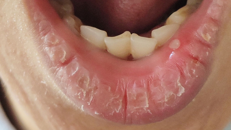 Nhận biết hình ảnh nhiệt miệng qua từng giai đoạn để chăm sóc đúng cách4