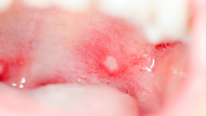 Nhận biết hình ảnh nhiệt miệng qua từng giai đoạn để chăm sóc đúng cách1