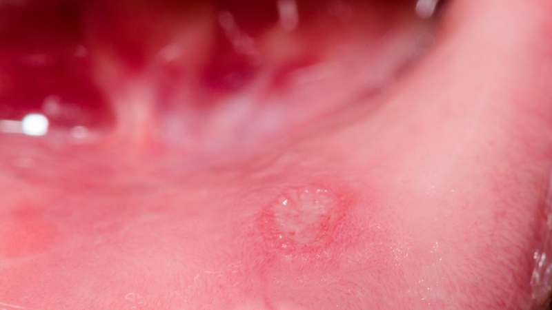 Nhận biết hình ảnh nhiệt miệng qua từng giai đoạn để chăm sóc đúng cách3