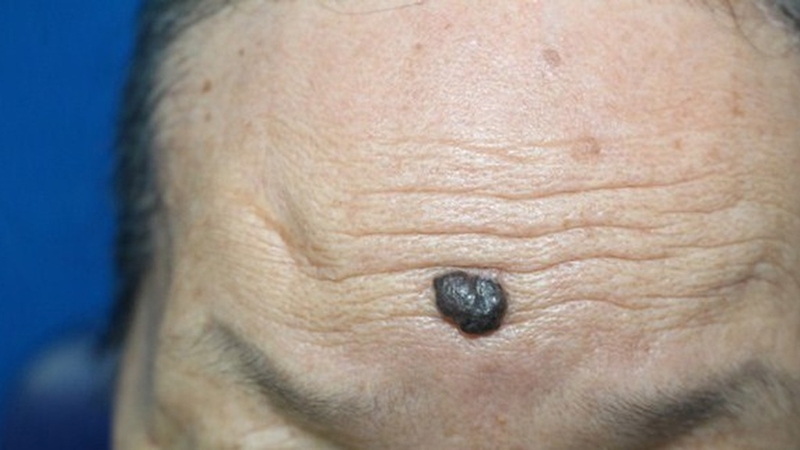 Nhận biết hình ảnh nốt ruồi ung thư: Dấu hiệu và phương pháp sàng lọc 1