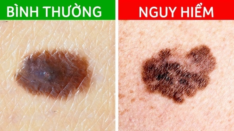 Nhận biết hình ảnh nốt ruồi ung thư: Dấu hiệu và phương pháp sàng lọc 2