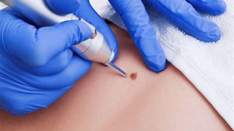 Nhận biết hình ảnh nốt ruồi ung thư: Dấu hiệu và phương pháp sàng lọc 3