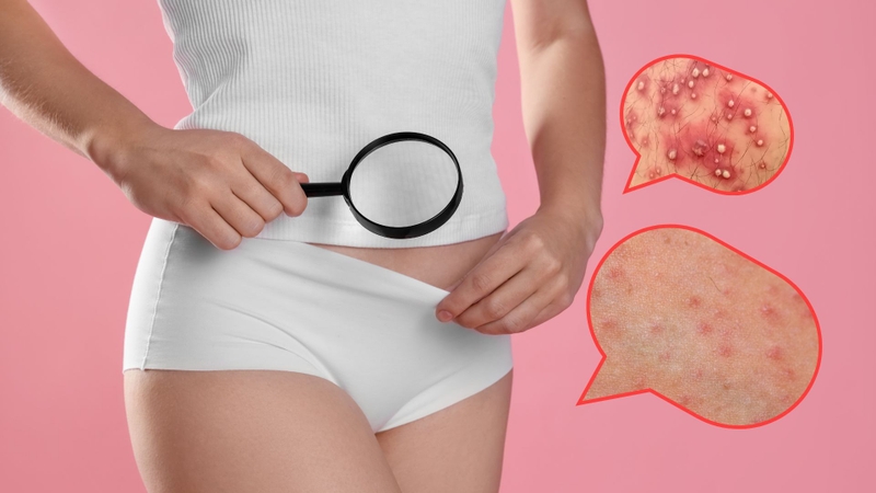 Khi bị viêm nang lông, sẽ xuất hiện các nhóm mụn nhỏ, đỏ hoặc có đầu trắng, xuất hiện xen kẽ trên da