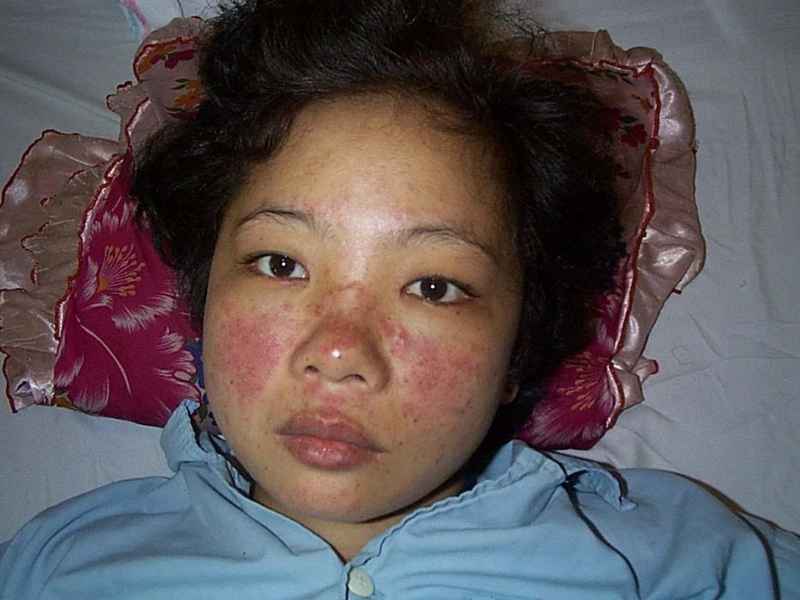 Lupus ban đỏ ở phụ nữ là một bệnh lý nguy hiểm, cần nhận biết bệnh sớm và có phương pháp điều trị đúng đắn 2