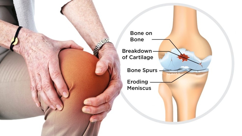 Nhận biết ngay 6 triệu chứng thoái hóa khớp gối để điều trị kịp thời! 1