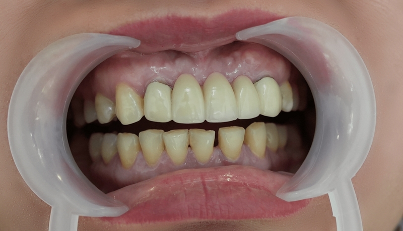 Nhận biết những dấu hiệu răng sứ bị hở, nguyên nhân và cách khắc phục 2