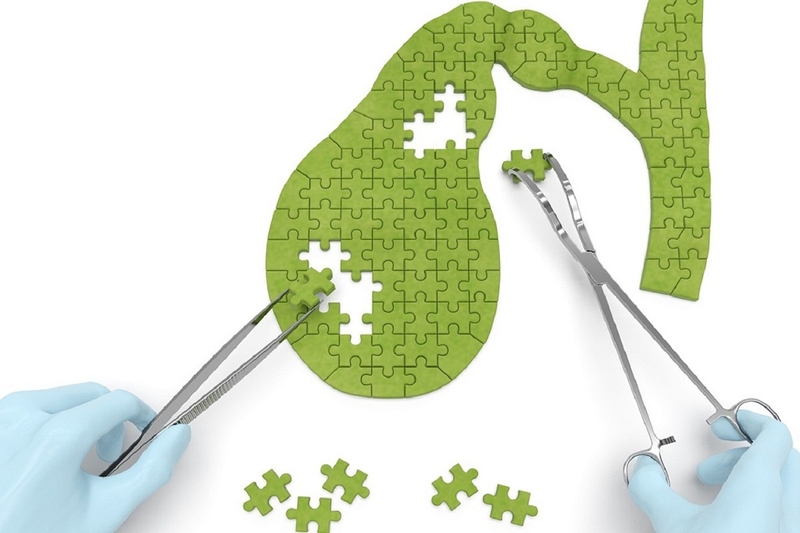 Nhận biết những dấu hiệu viêm túi mật cấp qua 4 giai đoạn tiến triển bạn cần biết 1