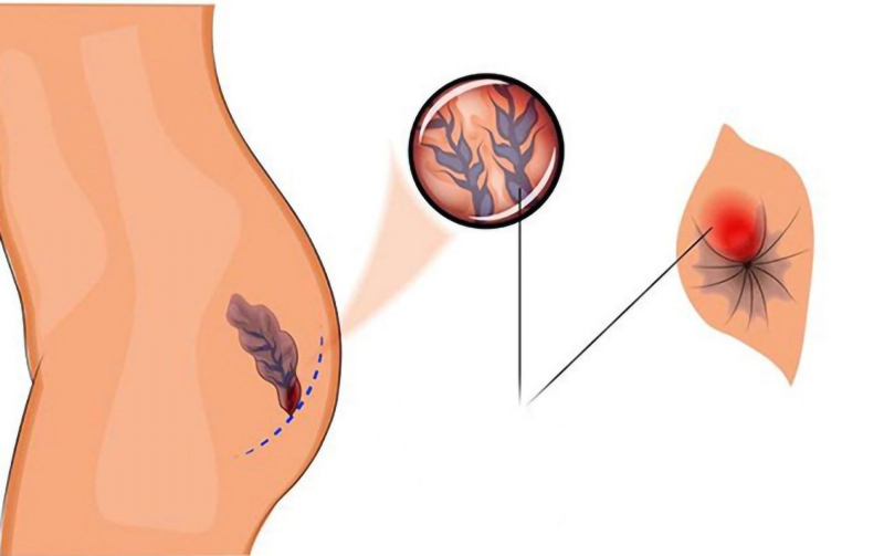 Bệnh trĩ ngoại cấp độ 1 là mức độ tình trạng bệnh nhẹ nhất nên không nhất thiết phải can thiệp bằng phẫu thuật