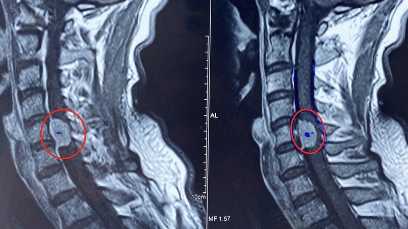 nhan-biet-tin-hieu-canh-bao-cac-trieu-chung-cua-benh-u-tuy-song 1