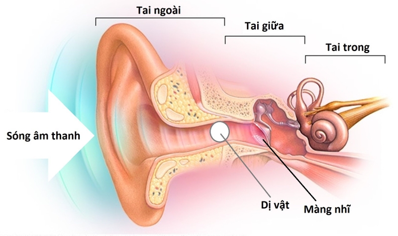 Nhận biết trẻ mắc dị vật tai mũi họng và cách xử trí 1