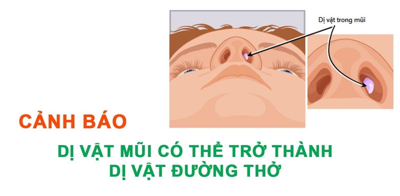 Nhận biết trẻ mắc dị vật tai mũi họng và cách xử trí 4