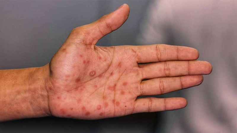 Nhận biết và xử lý mụn hiv giai đoạn đầu2