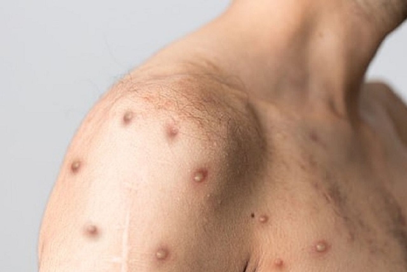 Nhận biết và xử lý mụn hiv giai đoạn đầu1