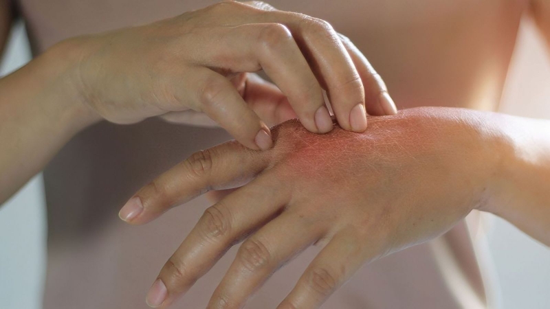 nhan-biet-va-xu-tri-khi-bi-di-ung-thuoc-tay 2