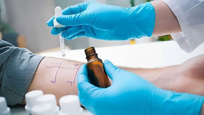 nhan-biet-va-xu-tri-khi-bi-di-ung-thuoc-tay 6