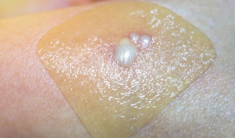 Nhận biết vết thương bị nhiễm trùng như thế nào? Có cách điều trị không? 2