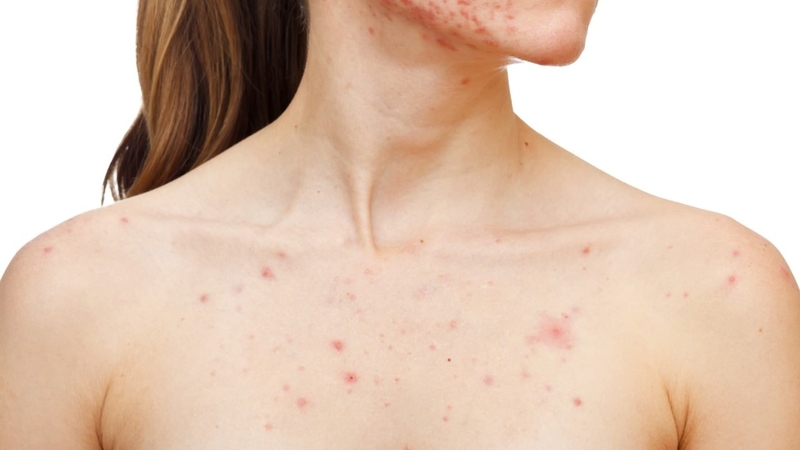 Nhận biết viêm nang lông ở ngực và cách điều trị hiệu quả 1