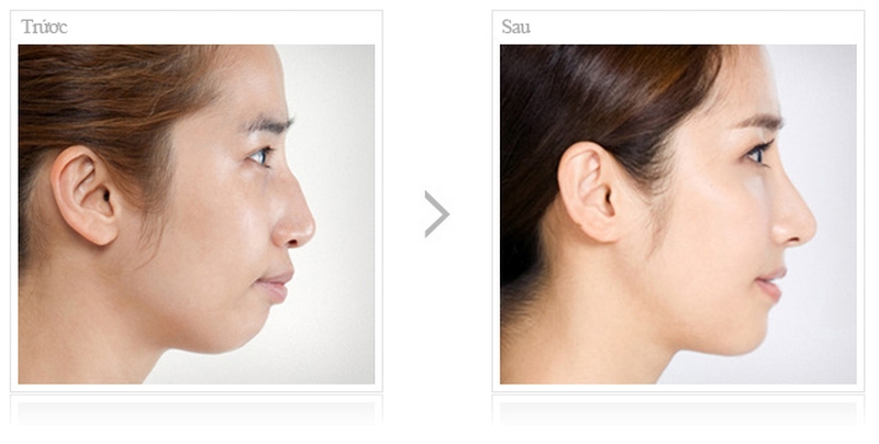 Tập Mewing có cải thiện mặt lệch không? 3