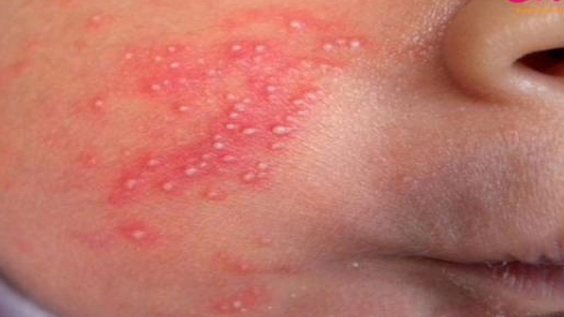 Nhận diện hình ảnh rôm sảy ở trẻ sơ sinh: Dấu hiệu và giải pháp điều trị 3