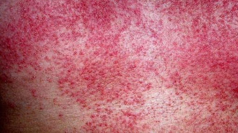 Nhận diện hình ảnh rôm sảy ở trẻ sơ sinh: Dấu hiệu và giải pháp điều trị 4