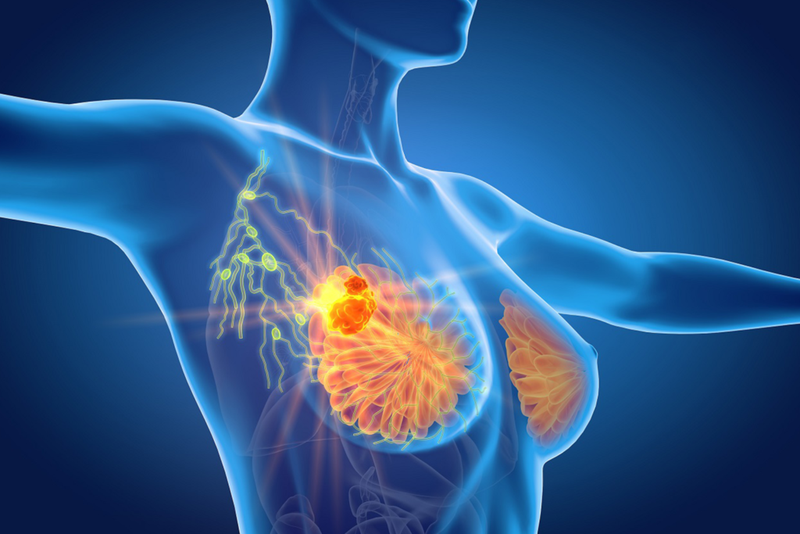 Nhân giảm âm Birads 3 là gì? Phân loại và cách điều trị 2