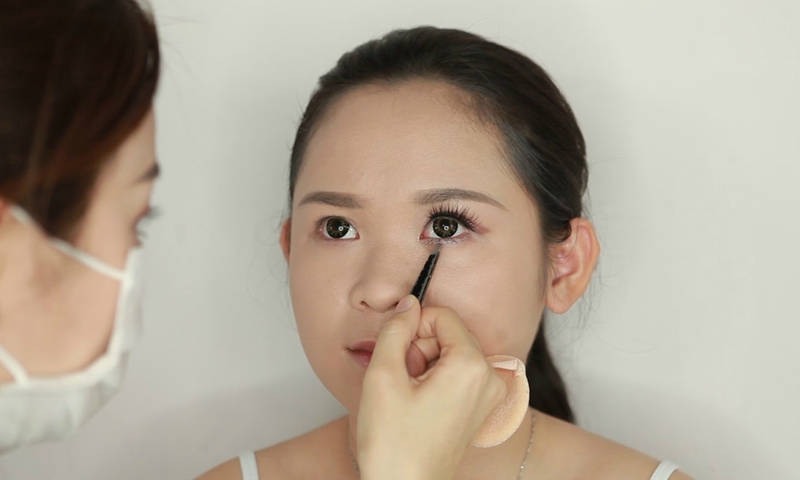 Nhấn mí Plasma là gì? Có hiệu quả không và duy trì kết quả được bao lâu? 1