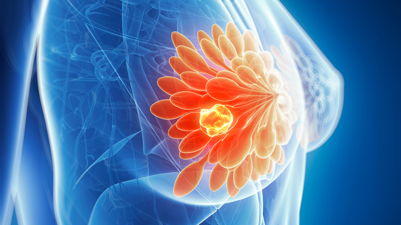 Nhận thức về ung thư vú: 7 sự thật phụ nữ cần biết 1