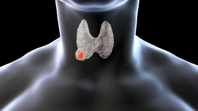 Nhân tuyến giáp 4mm có nguy hiểm không? -2