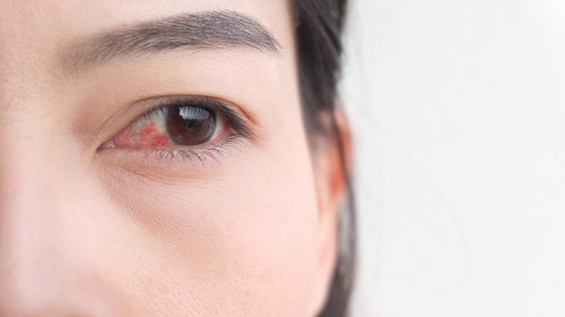 Nhãn viêm đồng cảm: Nguyên nhân, triệu chứng và cách điều trị 1