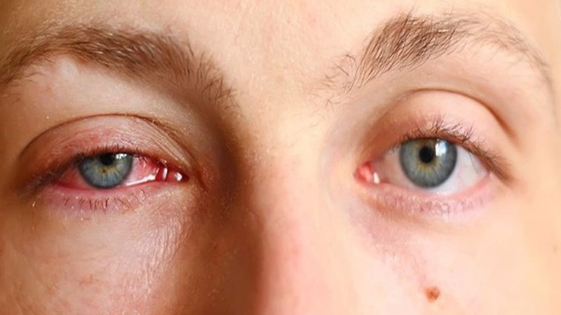 Nhãn viêm đồng cảm: Nguyên nhân, triệu chứng và cách điều trị 2