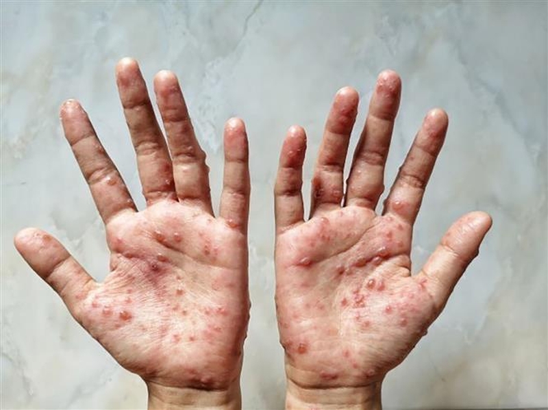 Bệnh đậu mùa khỉ và những biểu hiện thường thấy 3