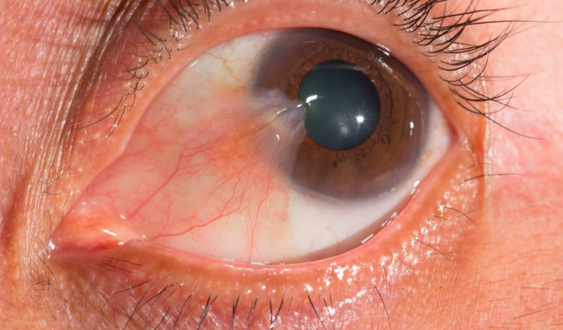 Nháy mắt phải nam là dấu hiệu cảnh báo bệnh lý gì? Ăn gì tốt cho mắt? 1