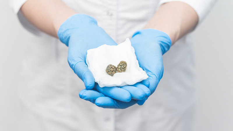 nhiem-cholesterol-thanh-tui-mat-la-gi (4).png