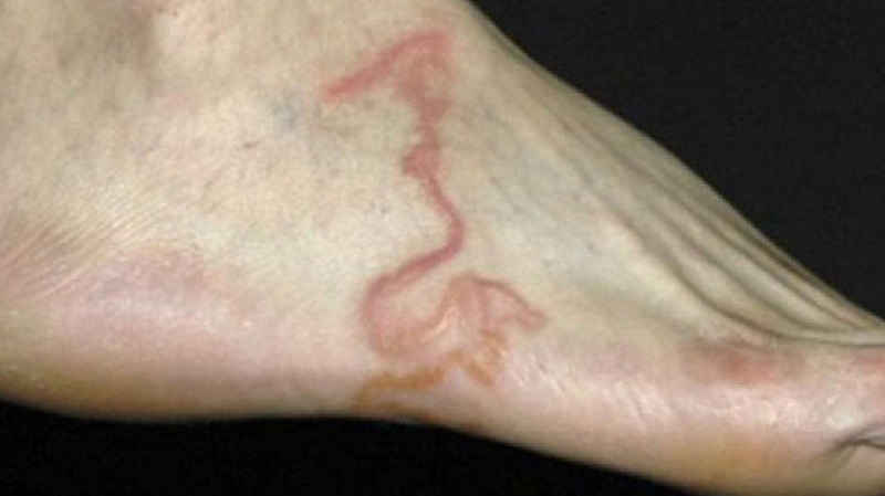 Giun móc là bệnh truyền nhiễm xâm nhập qua đường tiêu hoá