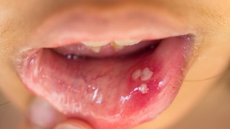nhiem-hpv-o-mieng-nguyen-nhan-va-cach-phong-ngua-benh-hieu-qua-3.jpg