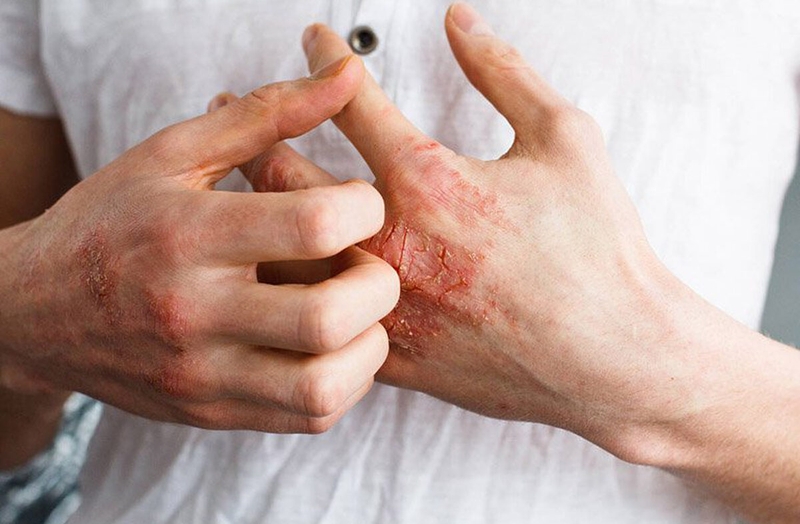 Nhiễm nấm có nghiêm trọng không?