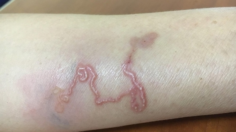 Nhiễm Strongyloides Stercoralis: Nguyên nhân, triệu chứng và điều trị 3