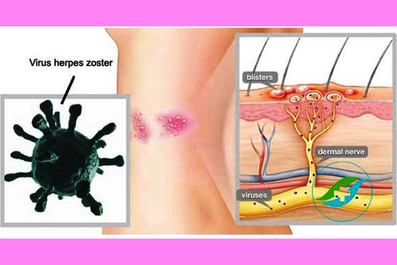 nhiễm trùng da ở trẻ sơ sinh 2