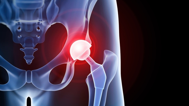 Nhiễm trùng khớp giả: Nguyên nhân, triệu chứng và cách điều trị 3