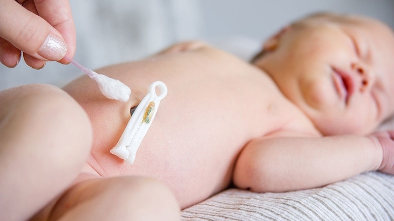 Cần theo dõi, quan sát kỹ tình trạng nhiễm trùng rốn khu trú ở trẻ