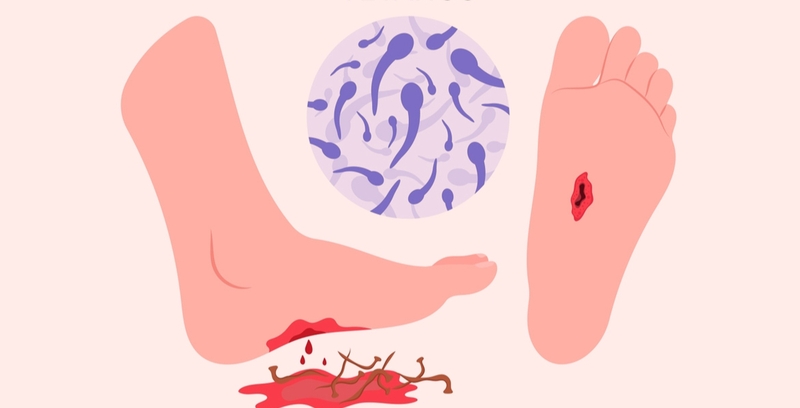 Nhiễm trùng uốn ván có nguy hiểm không? 1