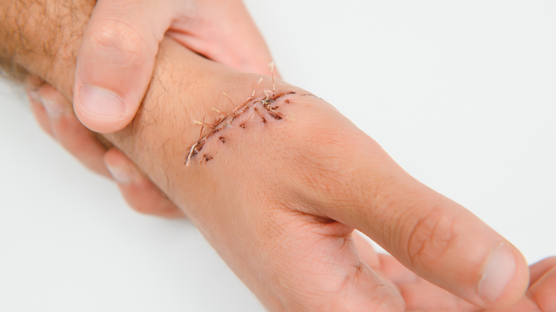 Nhiễm trùng vết mổ xuất hiện sớm trong vài ngày đầu hoặc muộn hơn sau khi xuất viện