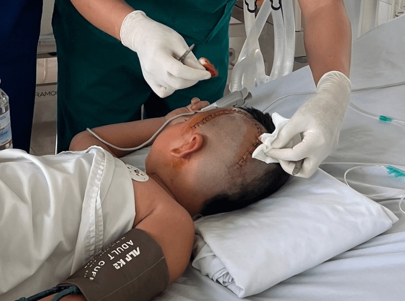 Nhiễm trùng vết mổ sọ não: Nguyên nhân, chẩn đoán và điều trị 2