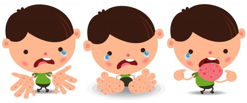 Nhiệt miệng có phải là dấu hiệu bệnh tay chân miệng ở trẻ 3