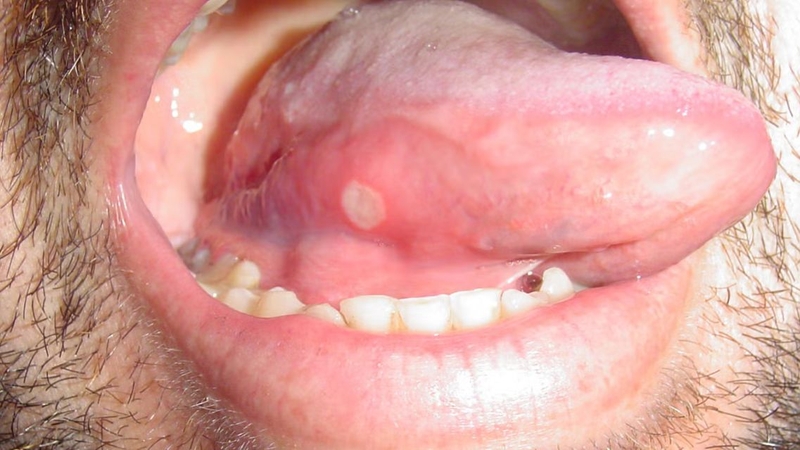 Nhiệt miệng dưới lưỡi thường gây đau rát, khó ăn uống và nói chuyện