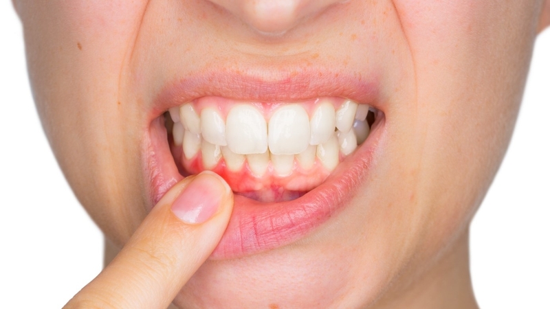 Nhiệt miệng ở nướu: Những điều bạn nên biết 1